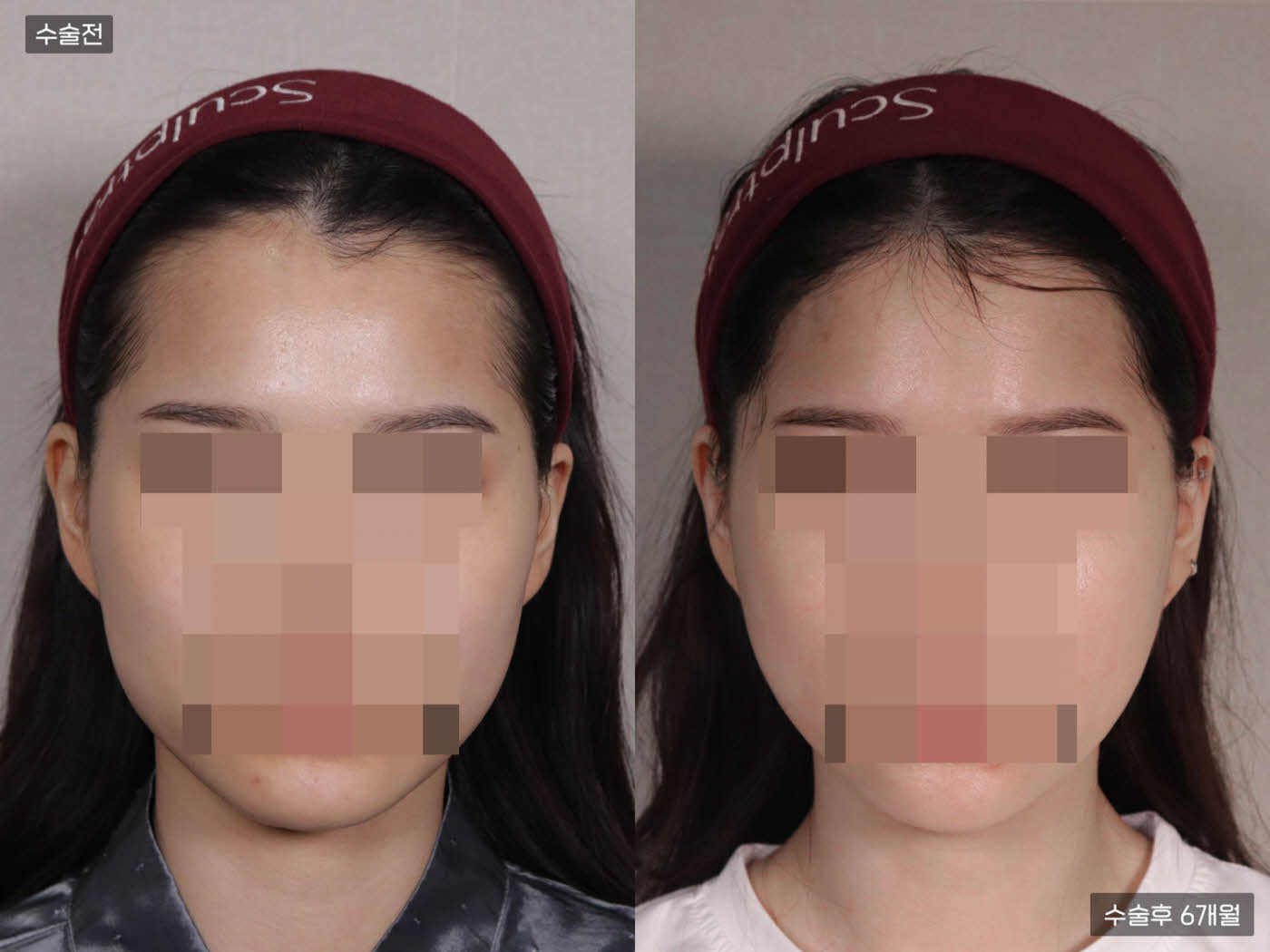 모발이식[절개 모발이식(2000모)]