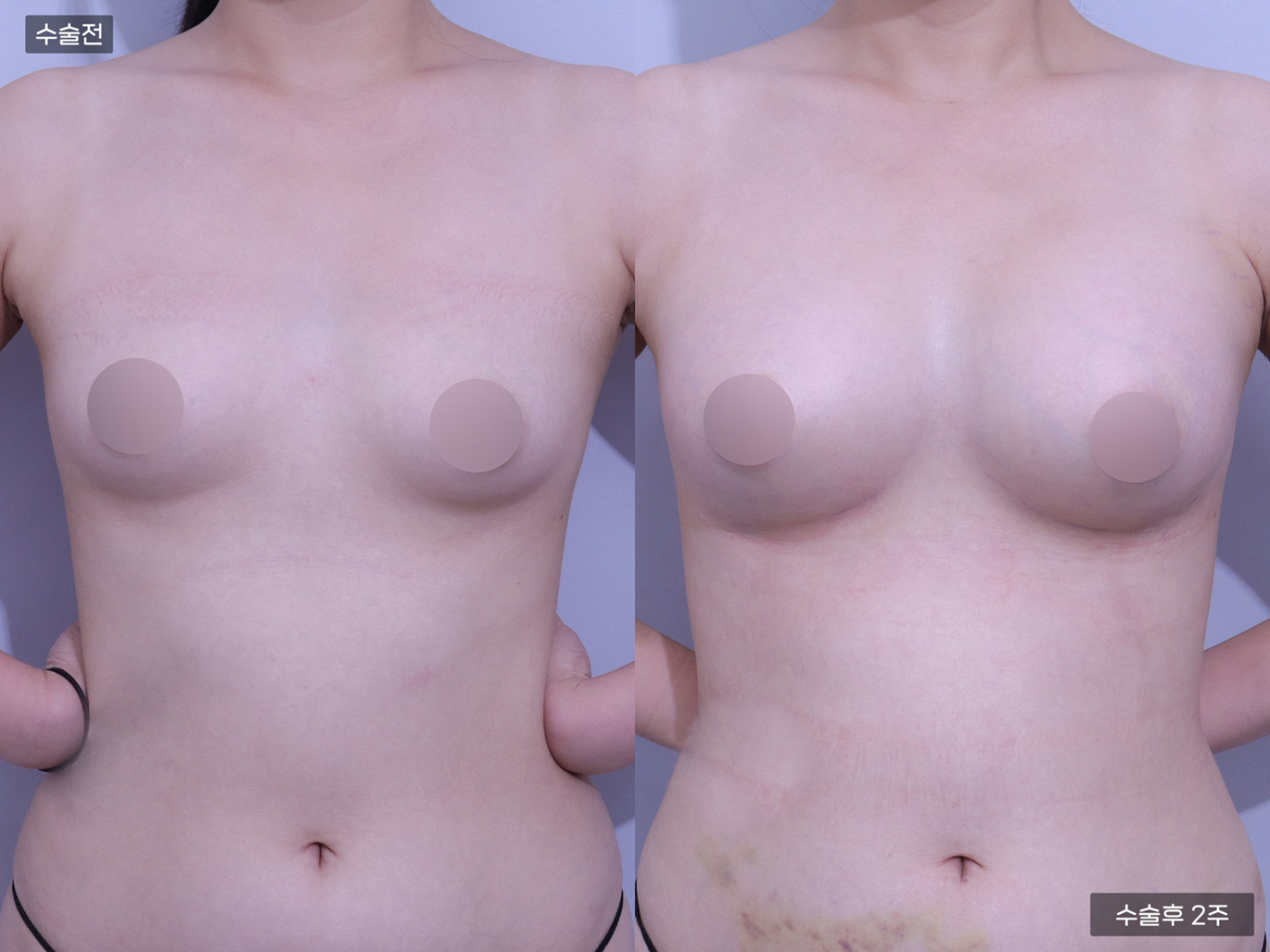 가슴성형 [가슴지방이식(350CC + 350CC)]