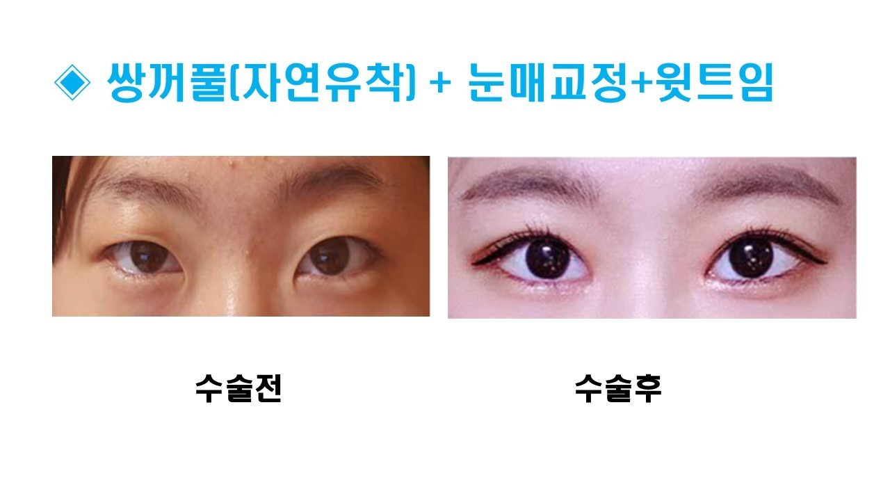 눈성형 [자연유착 쌍꺼풀 + 눈매교정 + 앞트임]