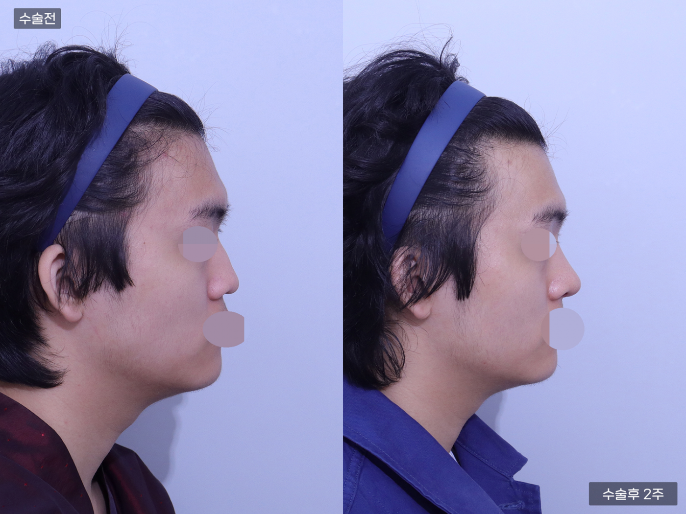 코끝(비중격) + 복코 + 매부리코