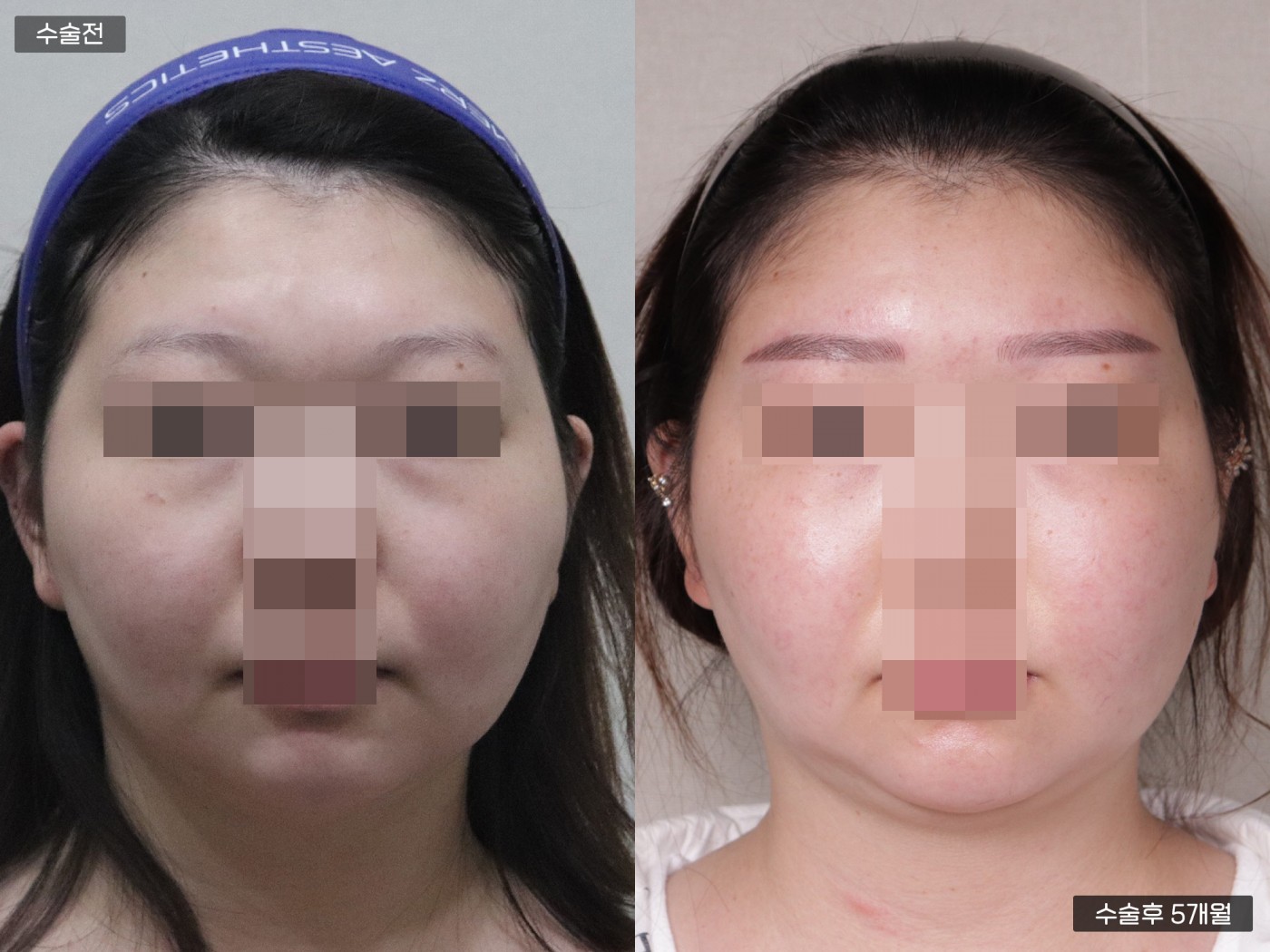 지방이식 [이마]