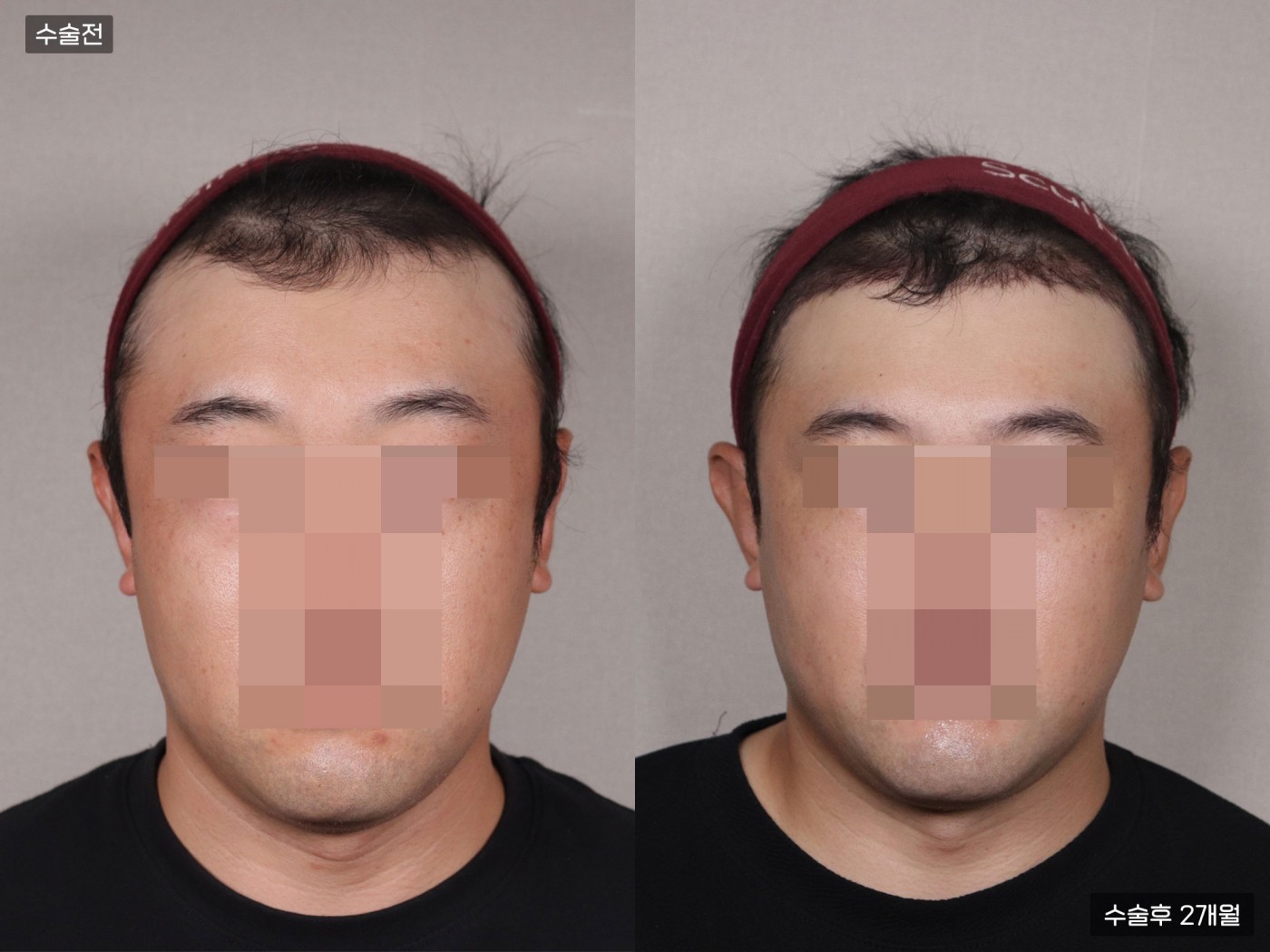 모발이식 [절개 모발이식(5000모)]