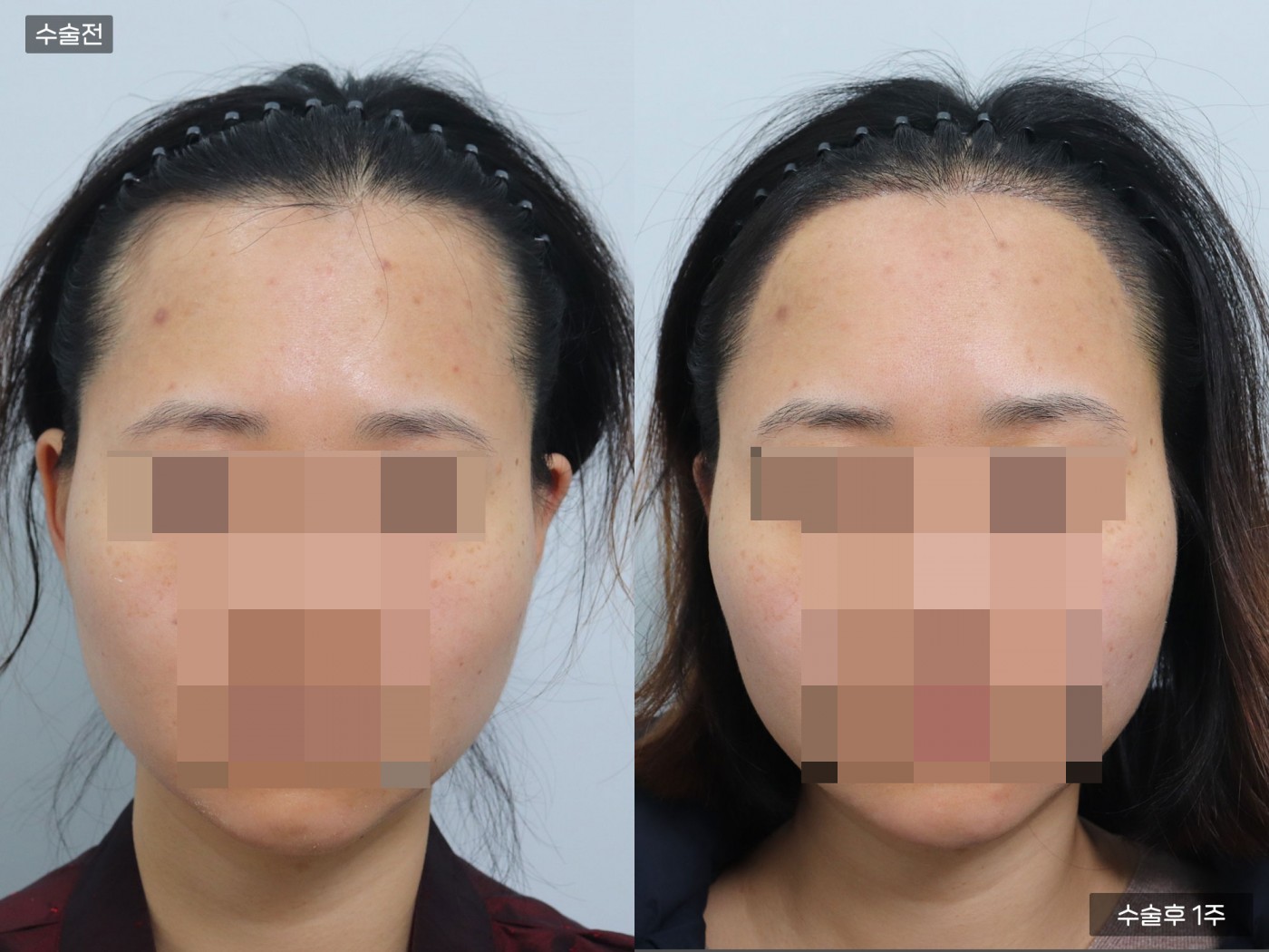 모발이식 [절개 모발이식(2000모)]