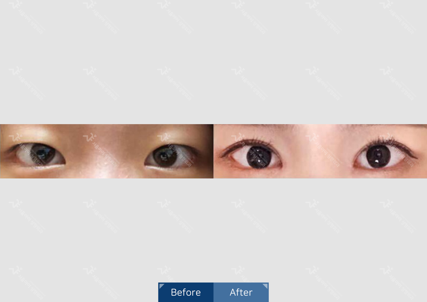 눈성형 [자연유착 쌍꺼풀 + 앞트임]