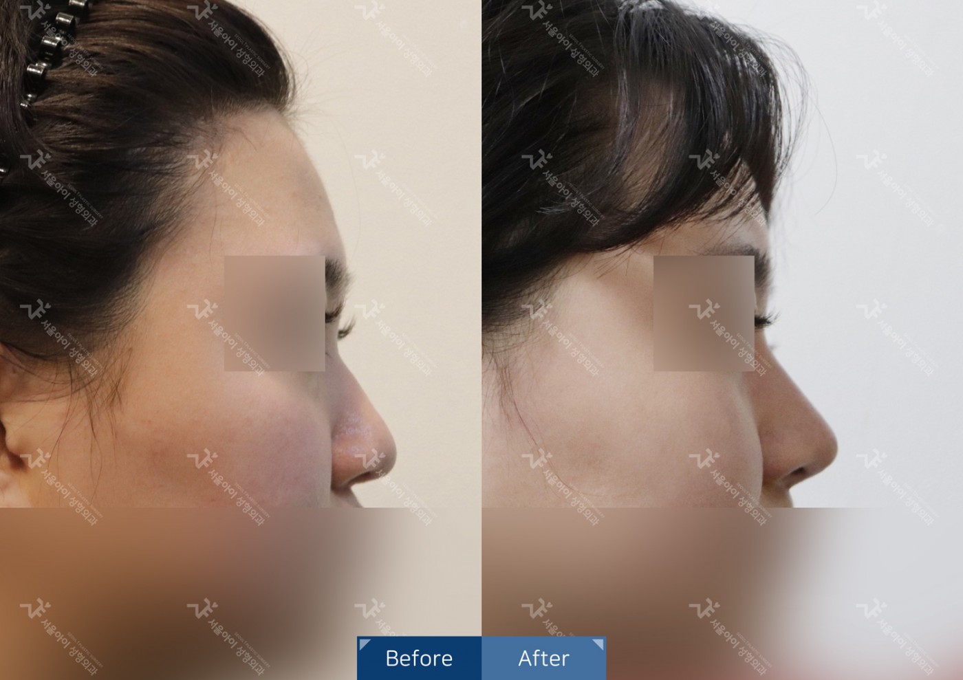 코성형 [비절개콧볼축소+하이코]