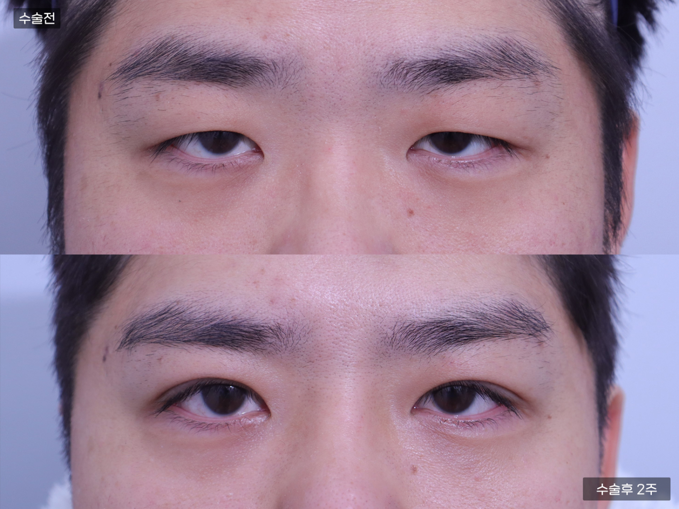 눈성형 [자연유착 쌍꺼풀 + 눈매교정]