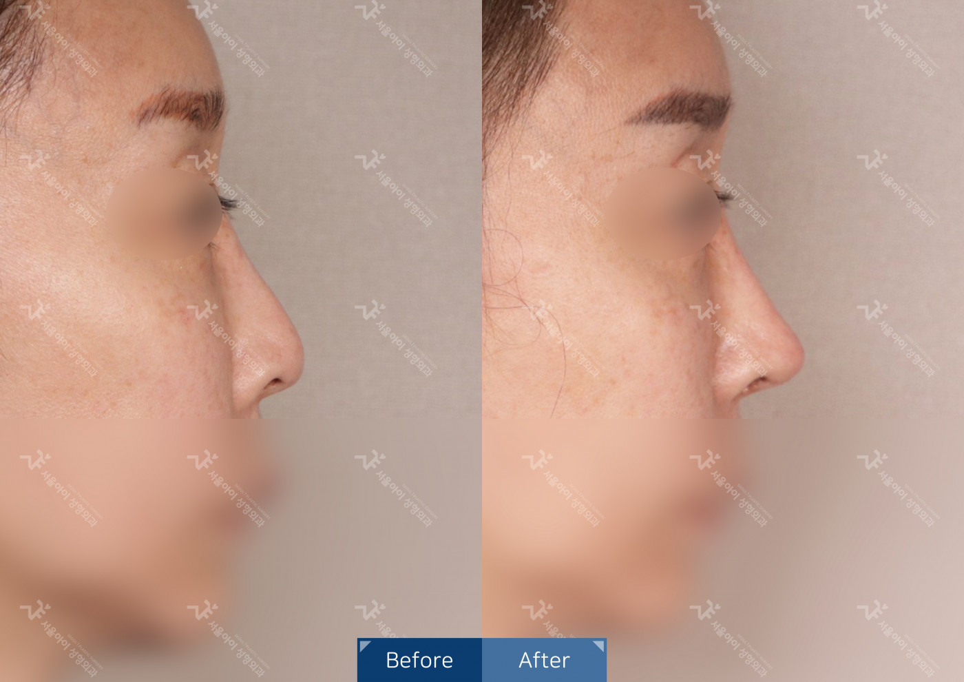 코성형[코끝조각술+비중격+메부리코+휜코교정술]