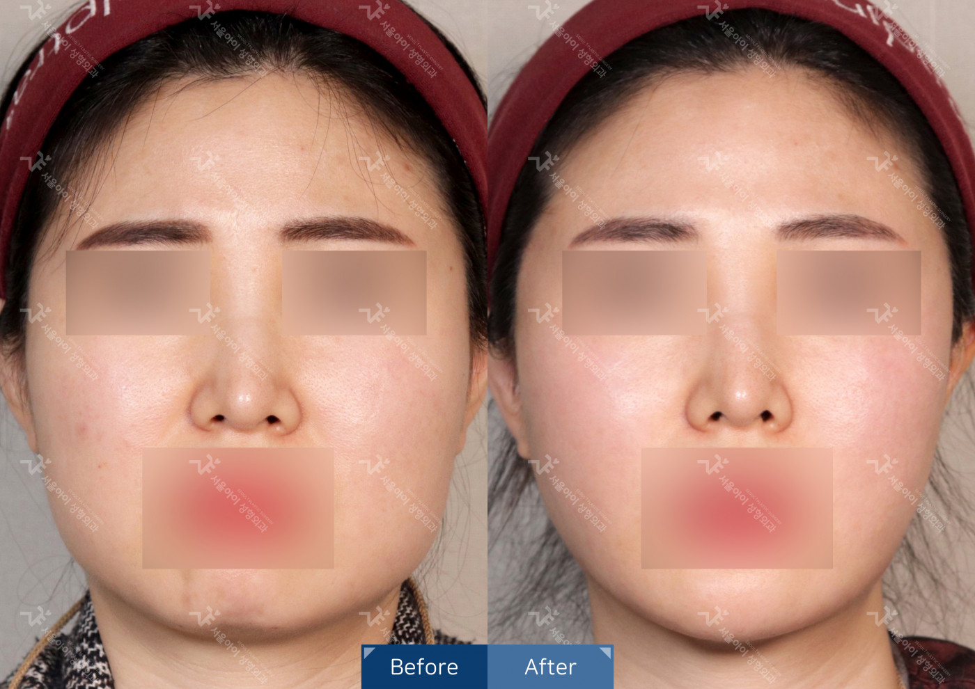 리프팅 [미니리프팅 + 사각턱보톡스]