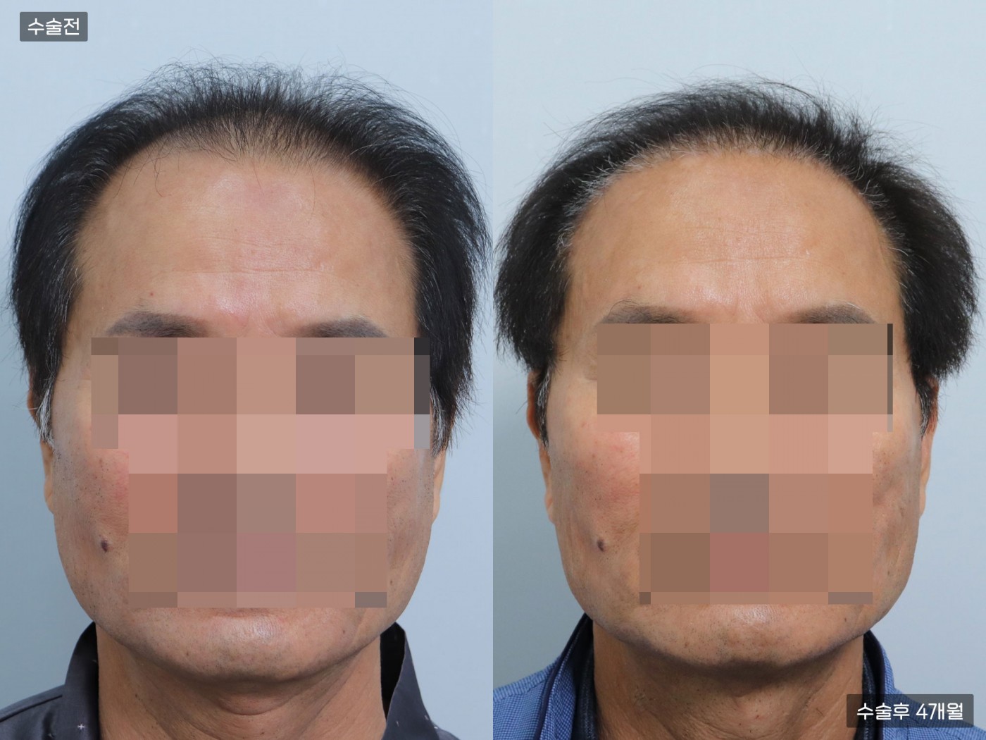 모발이식[절개 모발이식(4000모)]