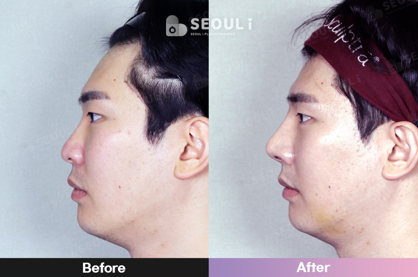 코끝(비중격) + 콧볼 축소술 + 매부리 교정