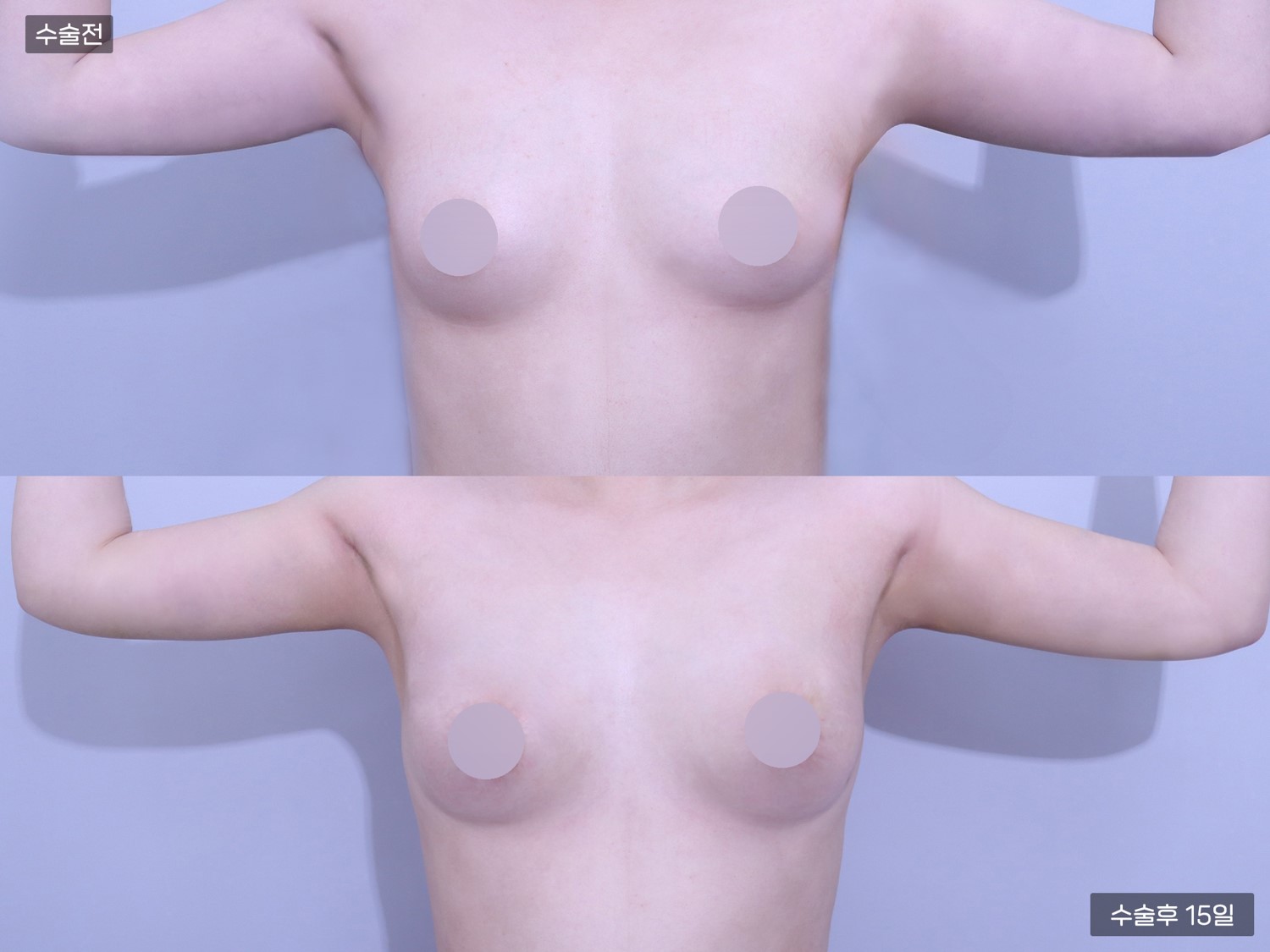 팔지방흡입 + 줄기세포 가슴지방이식 (200cc+200cc)