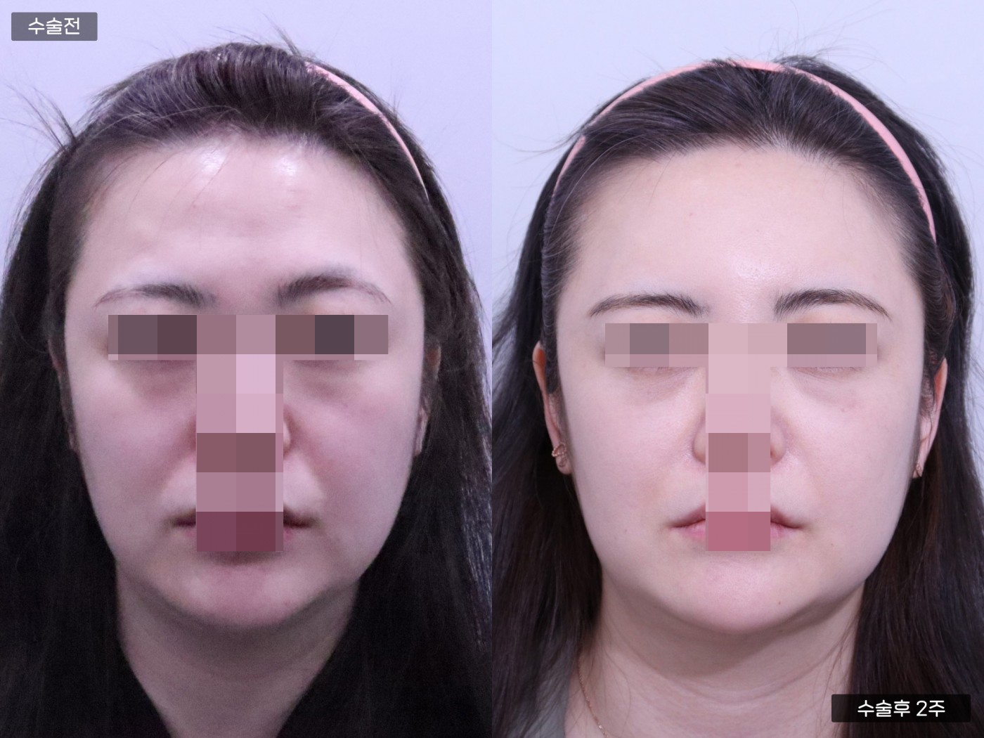 지방이식 [풀페이스]