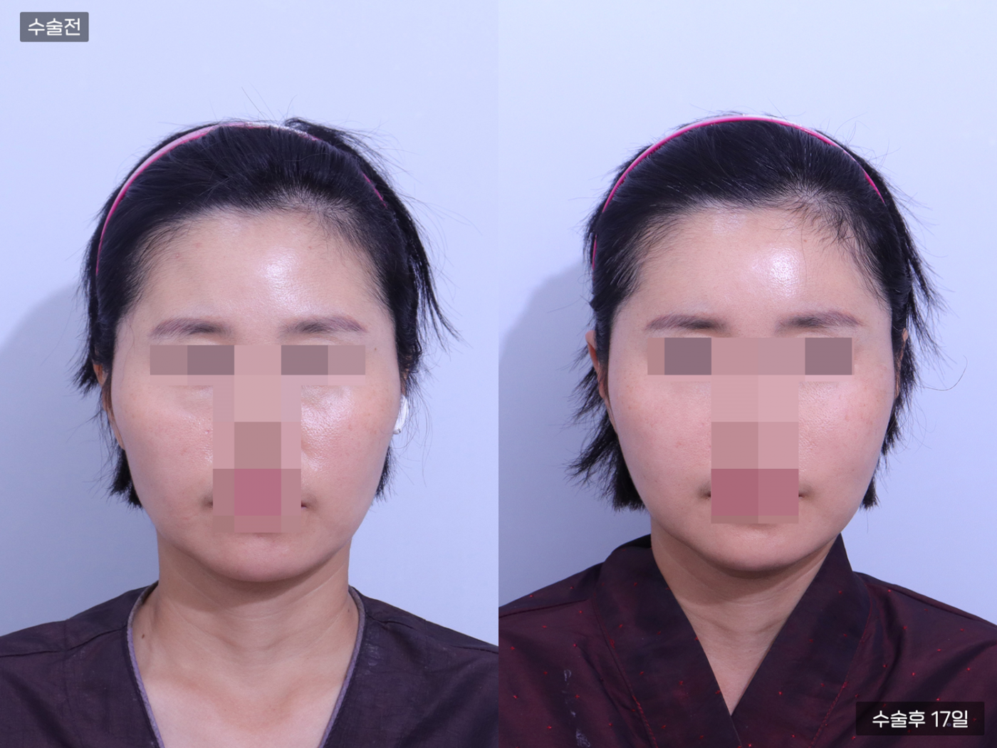 지방이식(풀페이스)