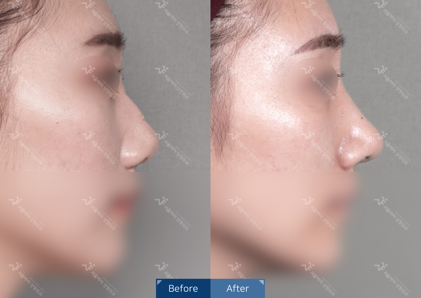코성형 [코끝조각술+비중격+메부리코+휜코교정술]