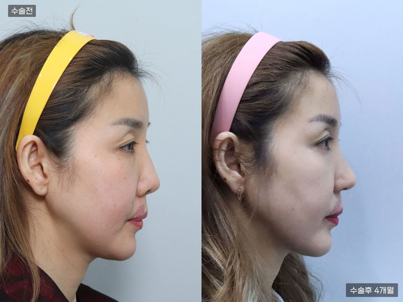 비공내리기 + 복코 + 매부리코