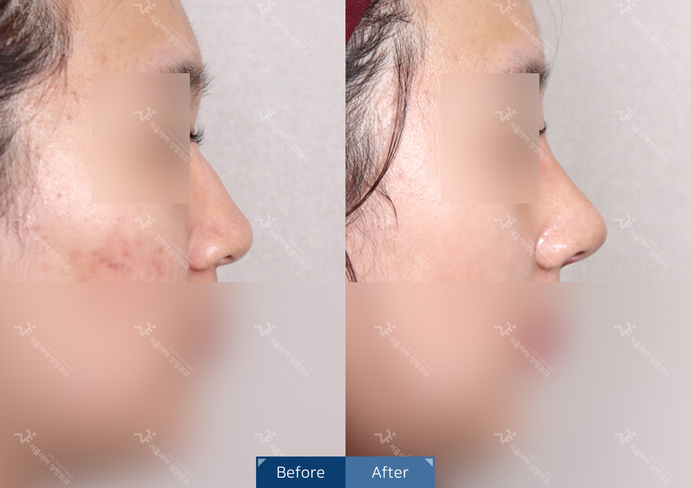 코성형 [융비술&코끝조각술(비중격)+복코교정+매부리코교정]