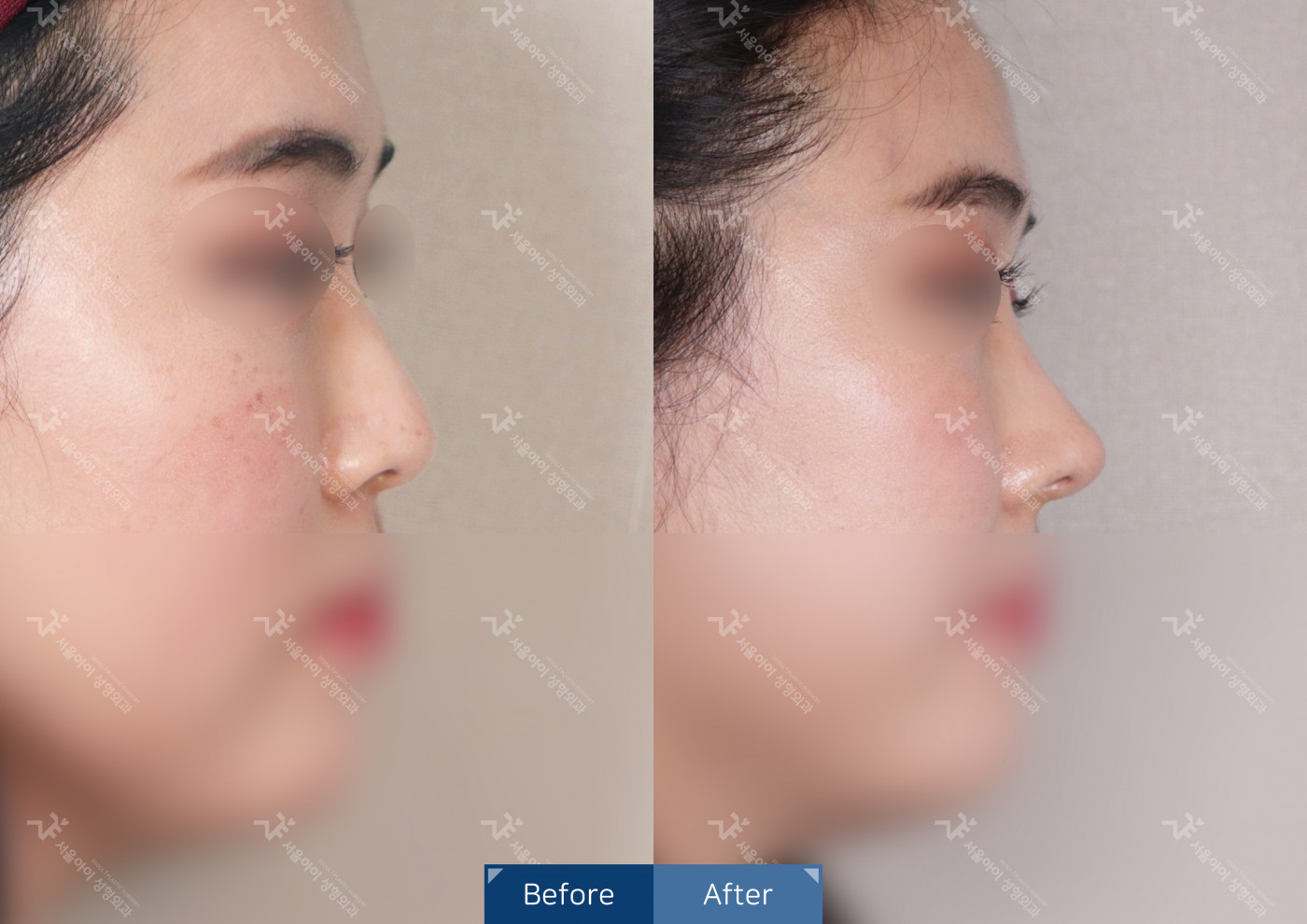 코성형[코끝조각술+비중격+복코교정술+짧은코교정]