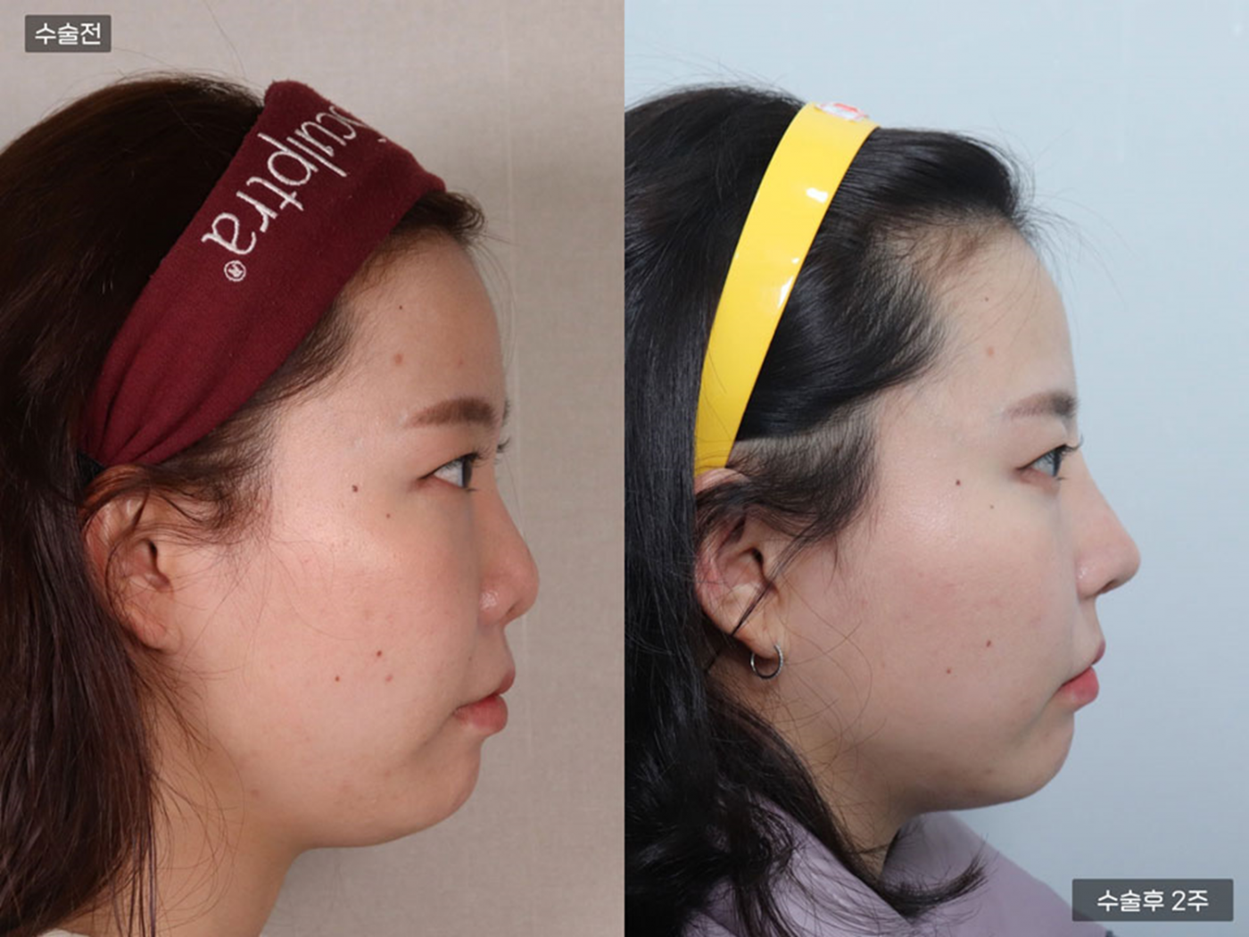 낮은코 + 비공내리기 + 복코