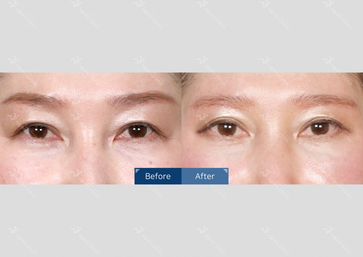 눈성형 [눈썹하거상술]