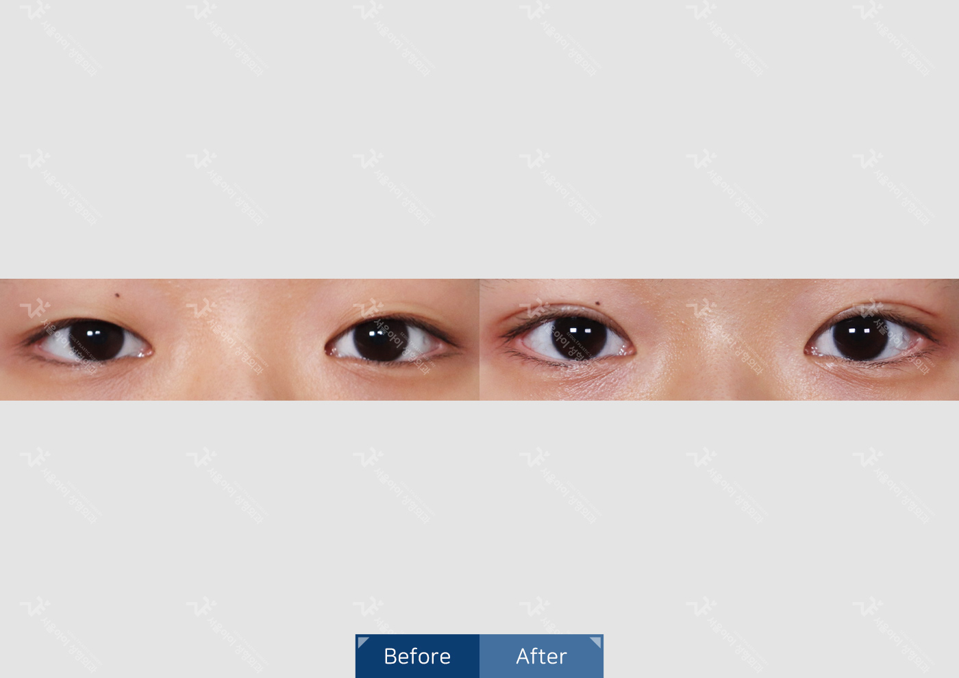 눈성형 [자연유착 쌍꺼풀 + 눈매교정]