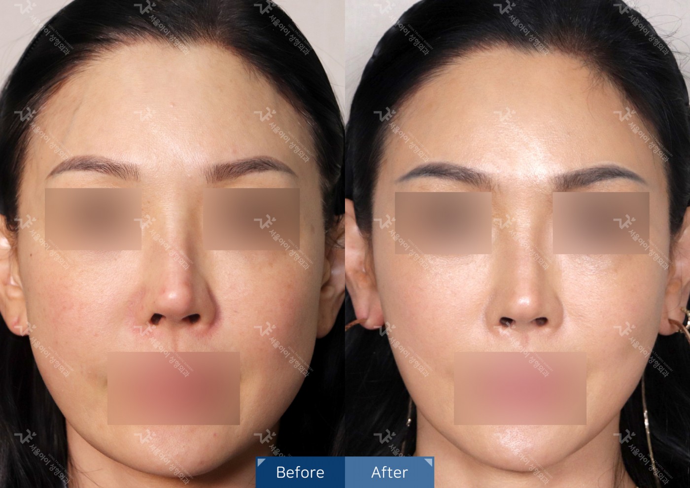 리프팅 [미니리프팅]