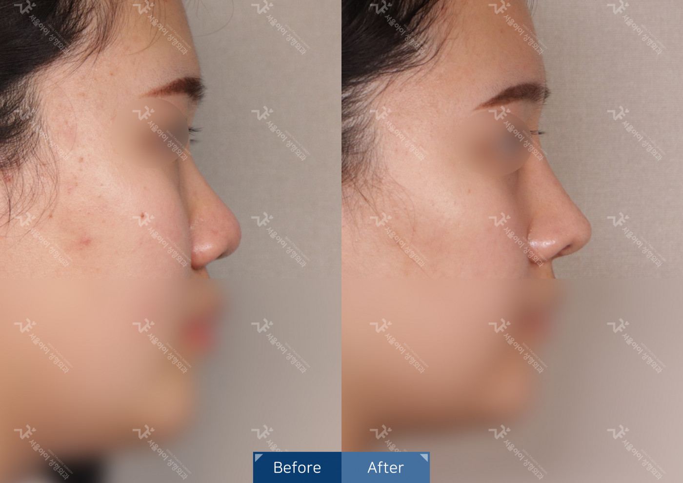 코성형[융비술&코끝조각술(비중격)+복코교정술+메부리]