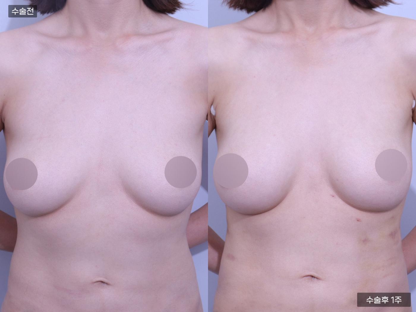 가슴성형 [가슴지방이식(100CC + 100CC)]