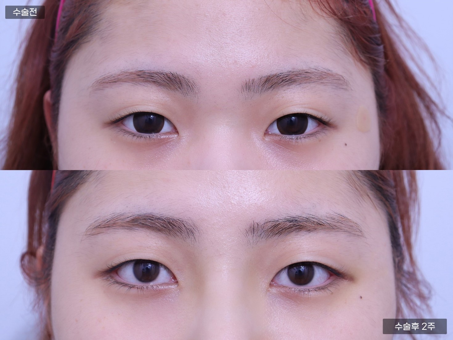 뒤트임 + 밑트임