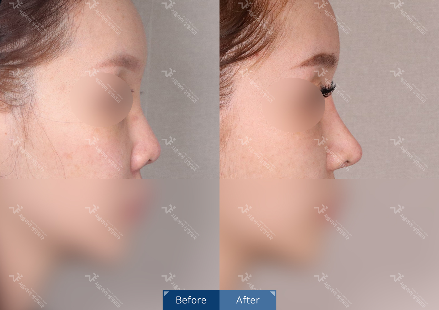 코성형 [융비술&코끝조각술(비중격)+복코교정술+짧은코교정]