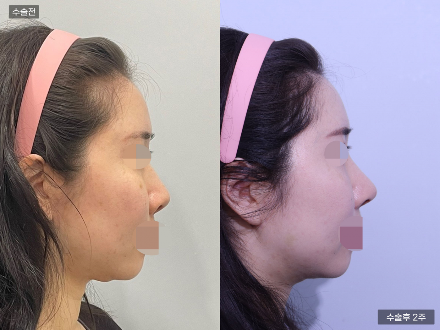 복코 + 매부리코 + 콧볼축소 + 코끝(비중격) + 비공내리기