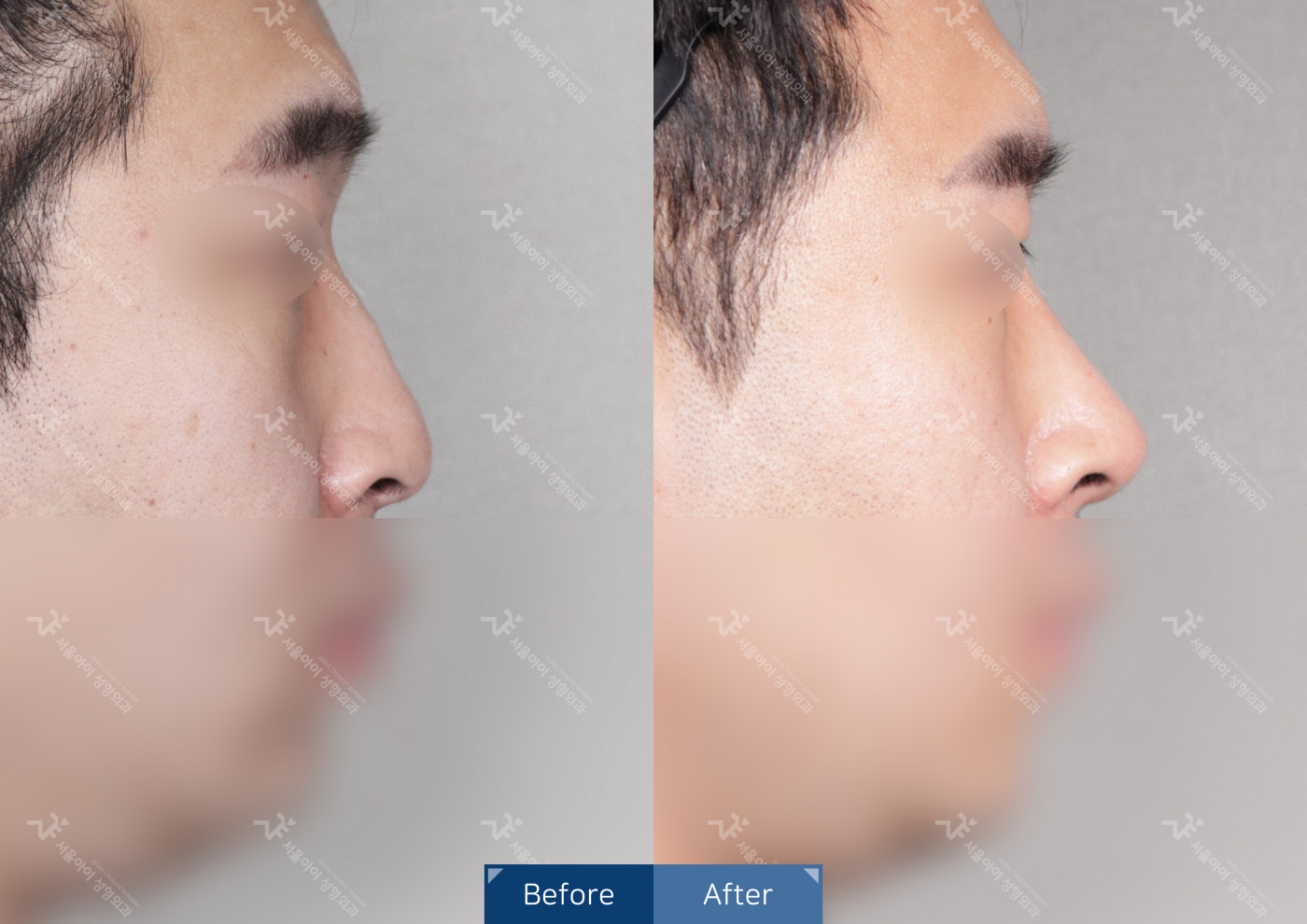 코성형 [코끝조각술+비중격+메부리코+복코교정술+휜코교정술+콧볼축소술]