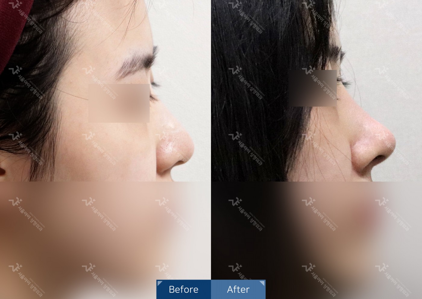 코성형 [융비술&코끝조각술(비중격)+매부리코교정+복코교정]