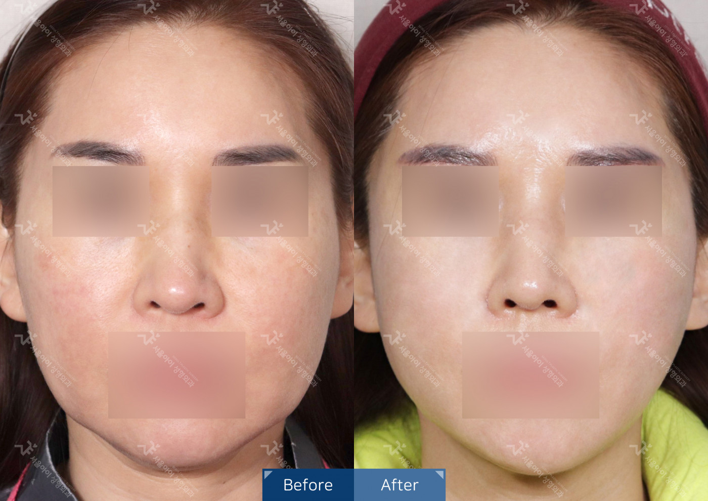 리프팅 [미니리프팅]