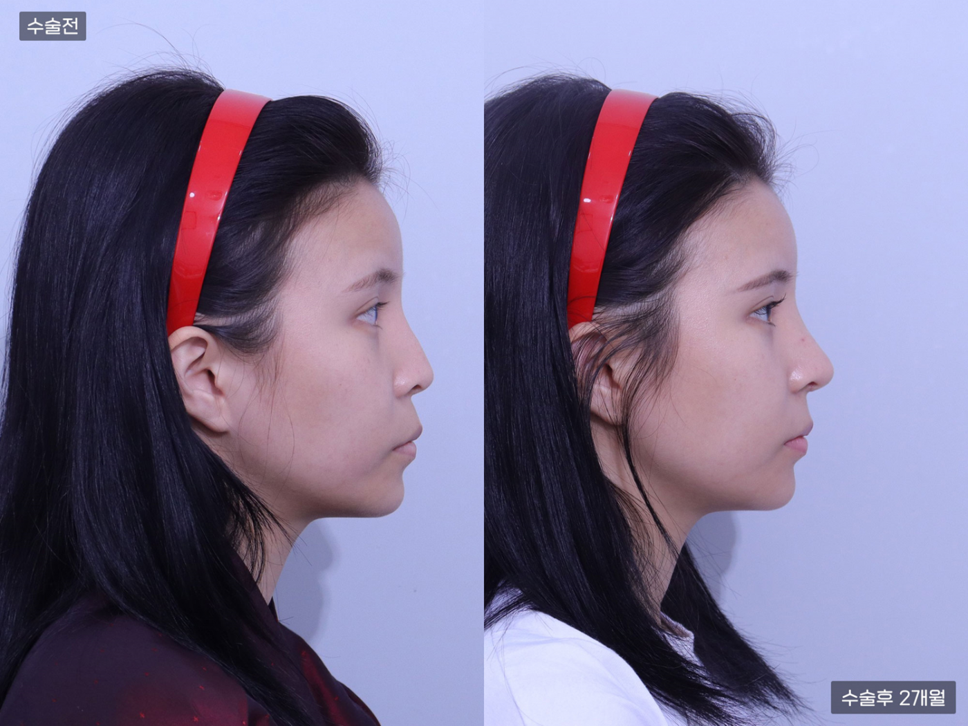 콧볼축소 + 콧볼축소 + 코끝