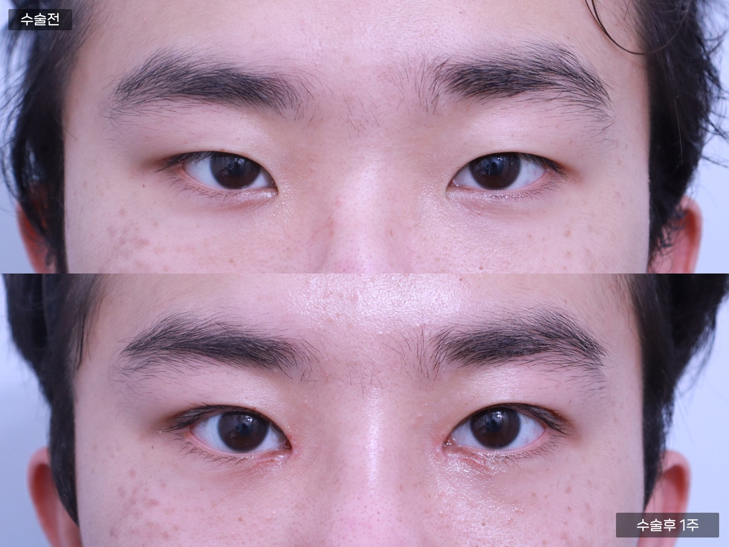 자연유착 쌍꺼풀 + 앞트임