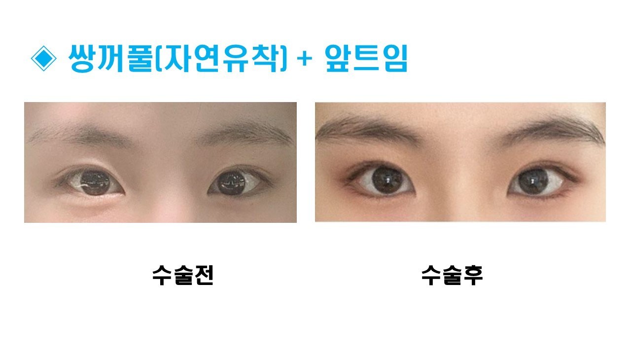 눈성형 [쌍꺼풀 + 앞트임]