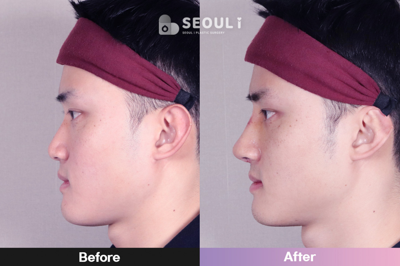 코끝(비중격) + 콧볼 축소술 + 매부리 교정