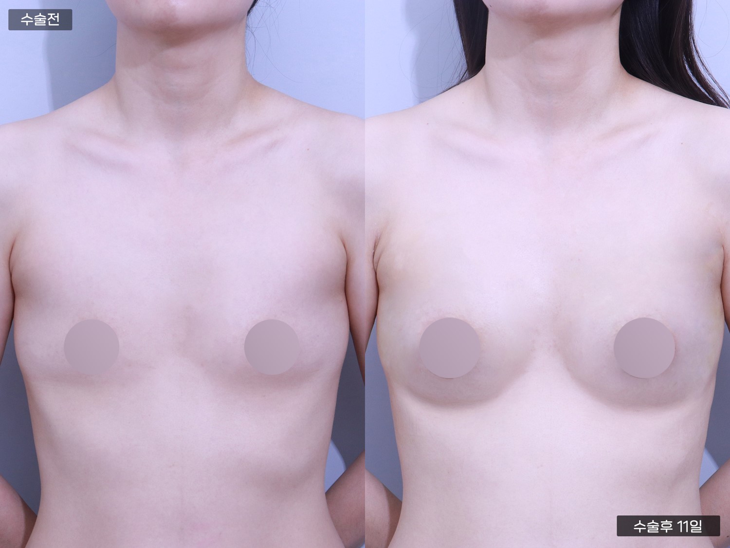 PRP 가슴지이 (250cc + 250cc)