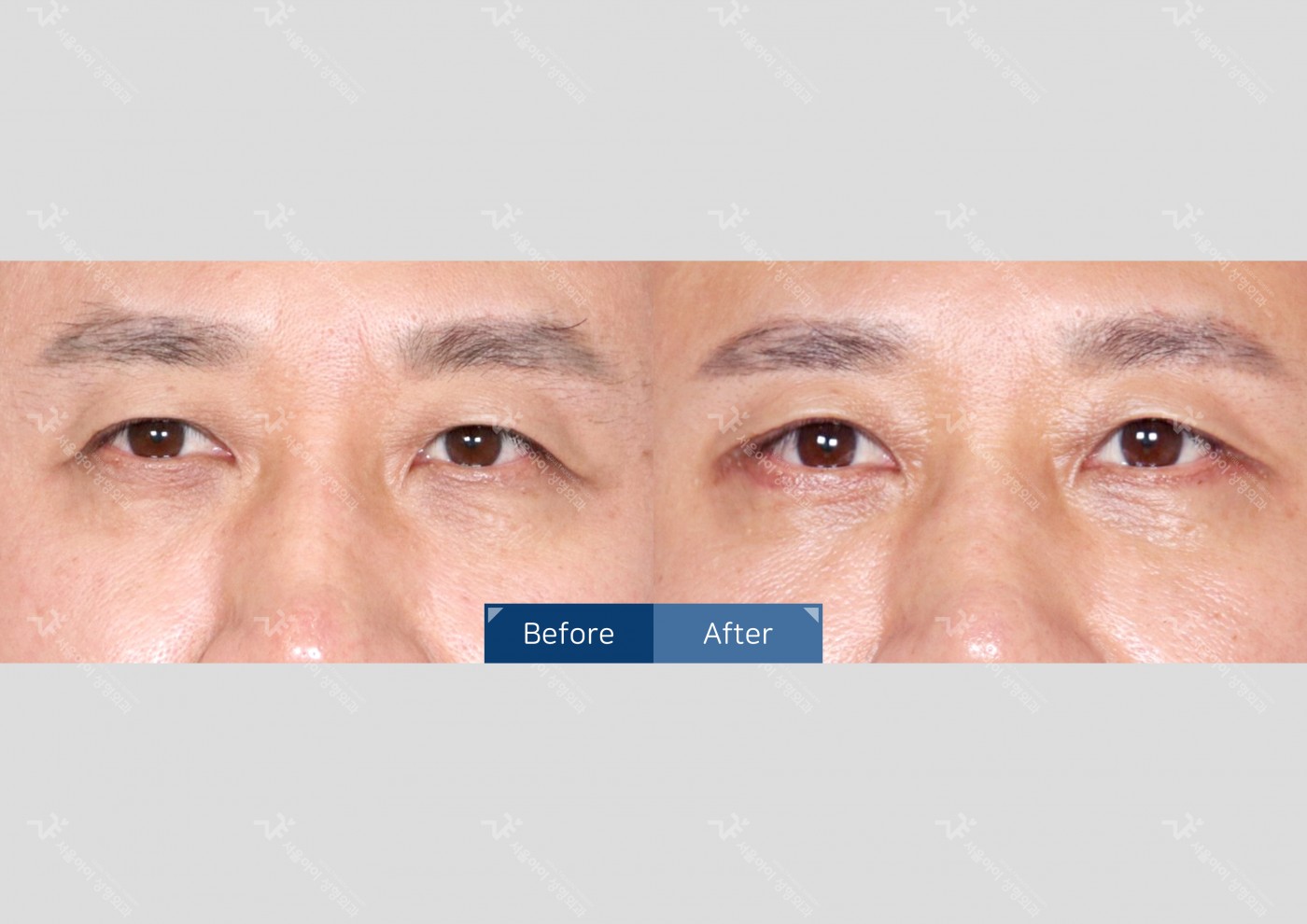 눈성형 [하안검]