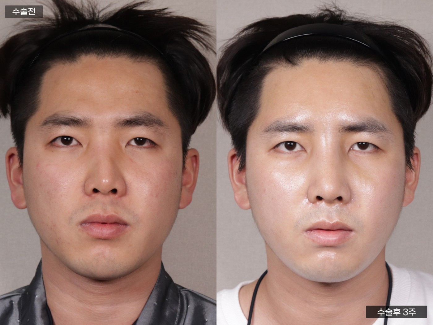 지방이식 [이마 + 비중격 + 복코 매부리코 교정]