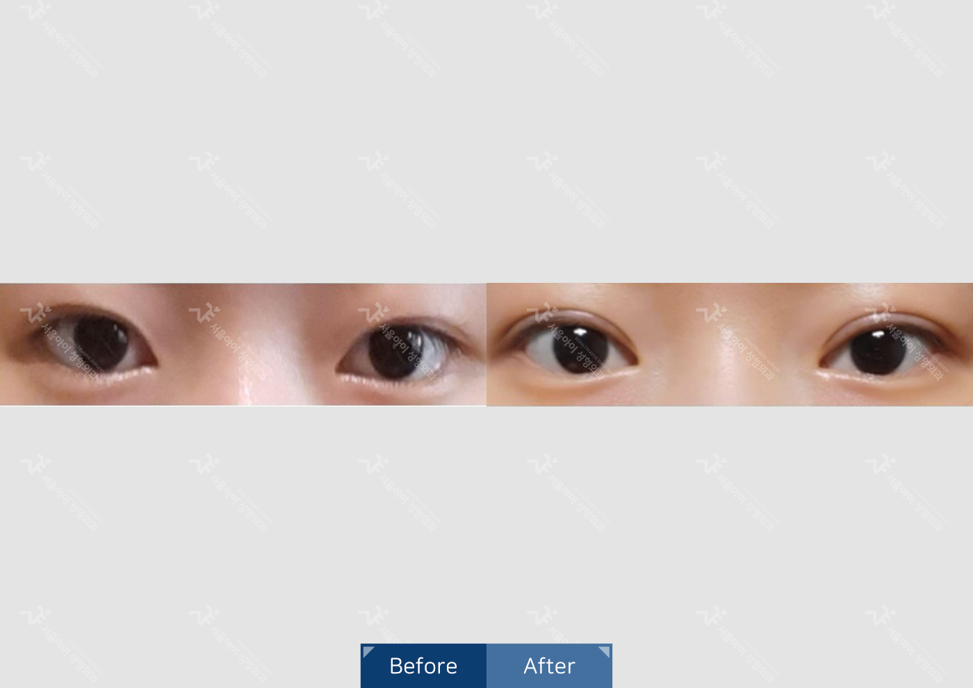 눈성형 [자연유착 쌍꺼풀]