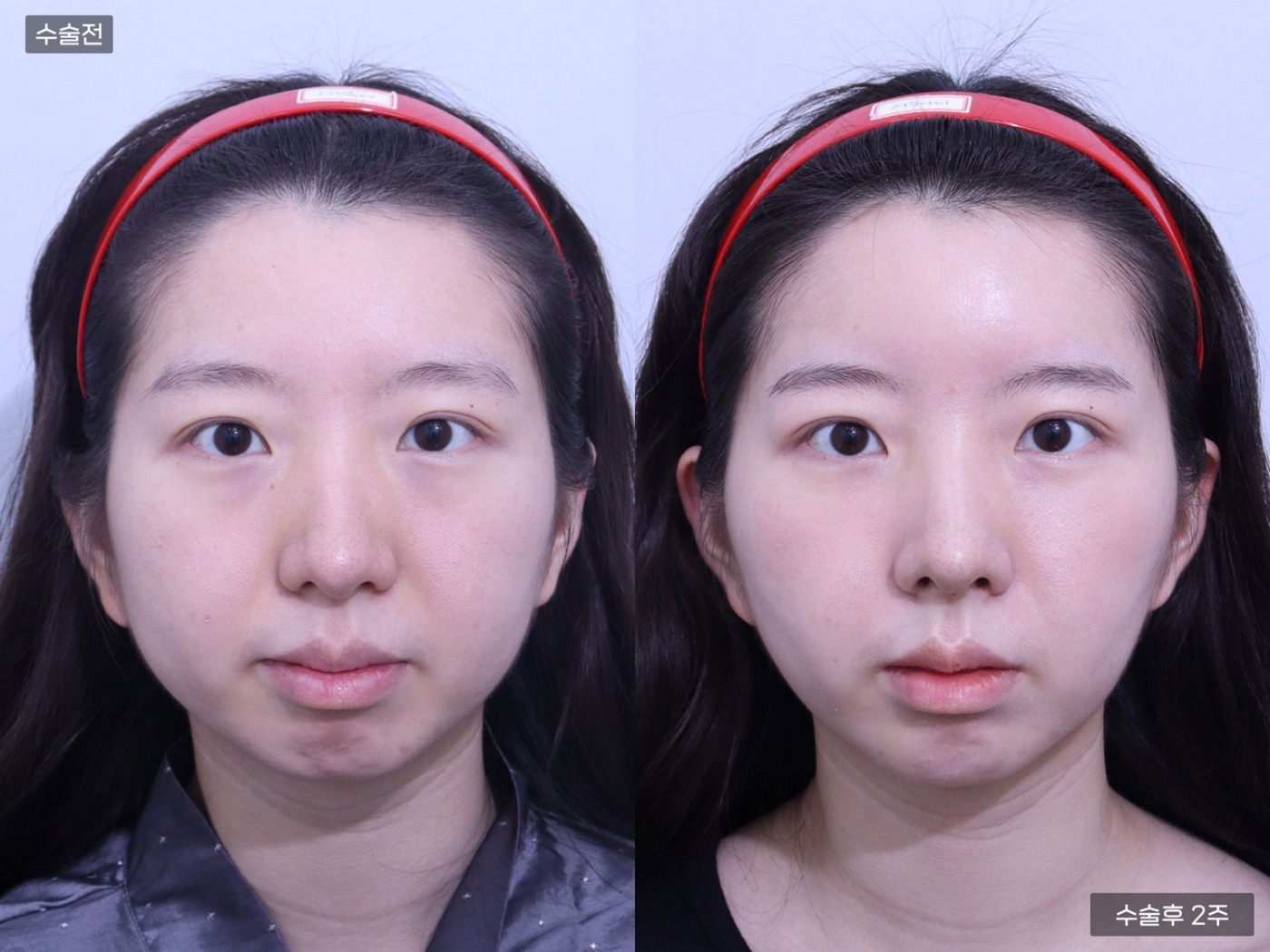 지방이식 [이마]