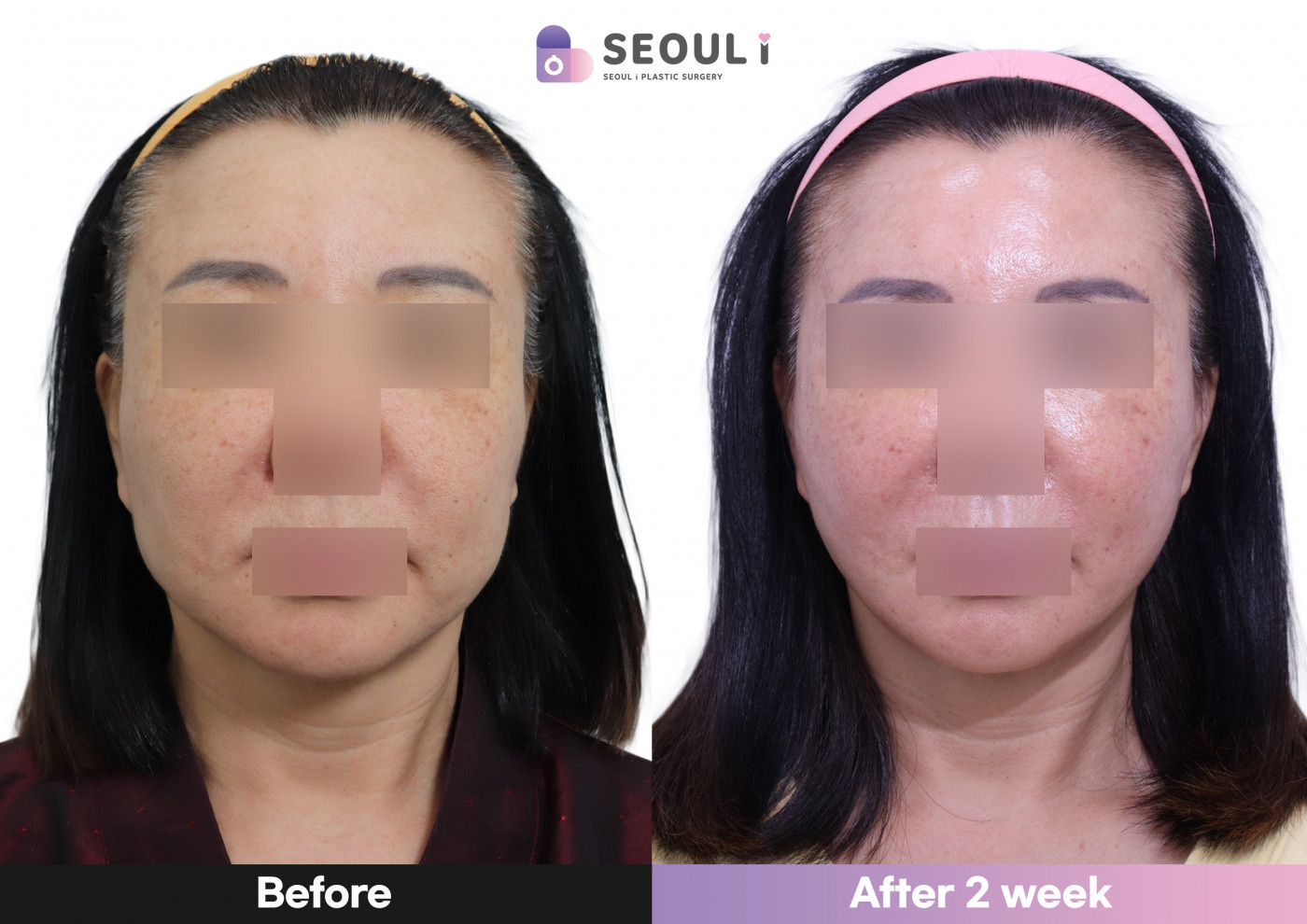 리프팅 [관자리프팅 + 팔자잼버실 + 앞볼 쥬베룩볼륨]