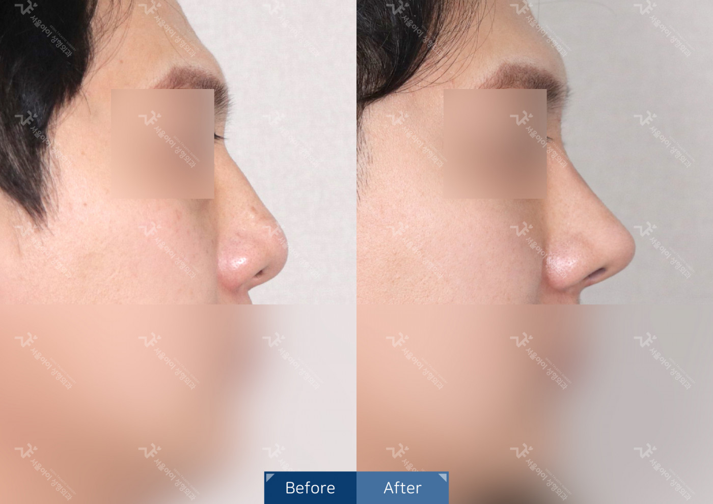 코성형 [코끝조각술(비중격)+복코교정+매부리코교정]