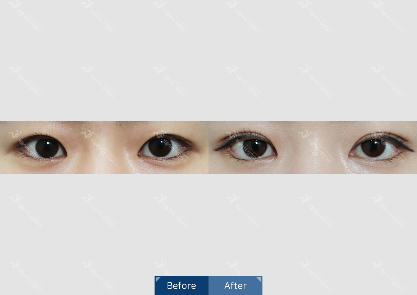 눈성형 [자연유착 + 눈매교정]