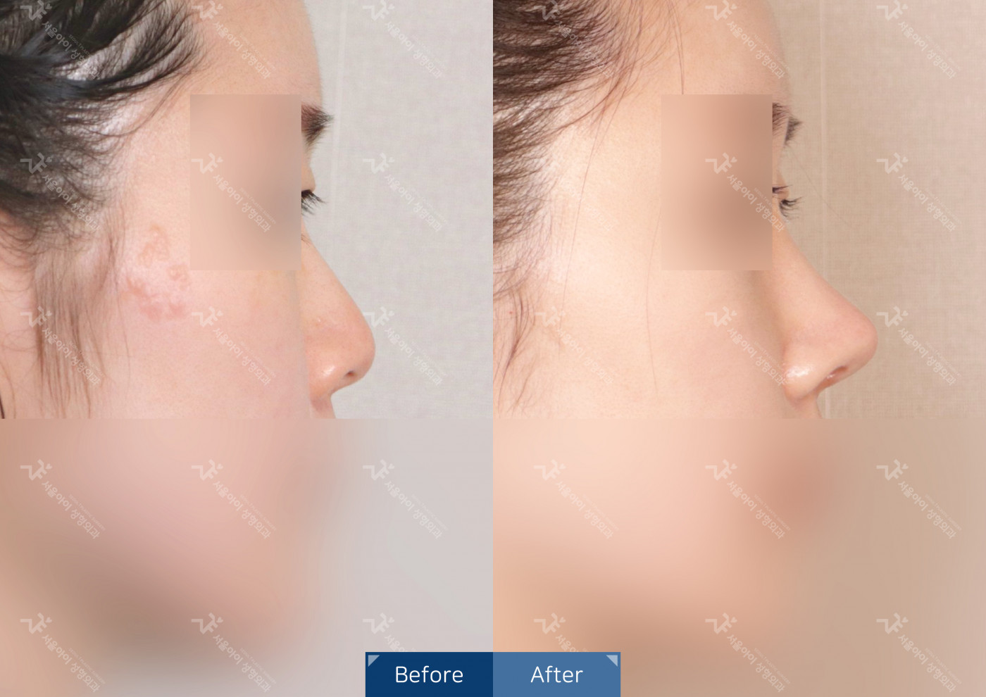 코성형 [코끝조각술(비중격)+복코교정+짧은코교정]