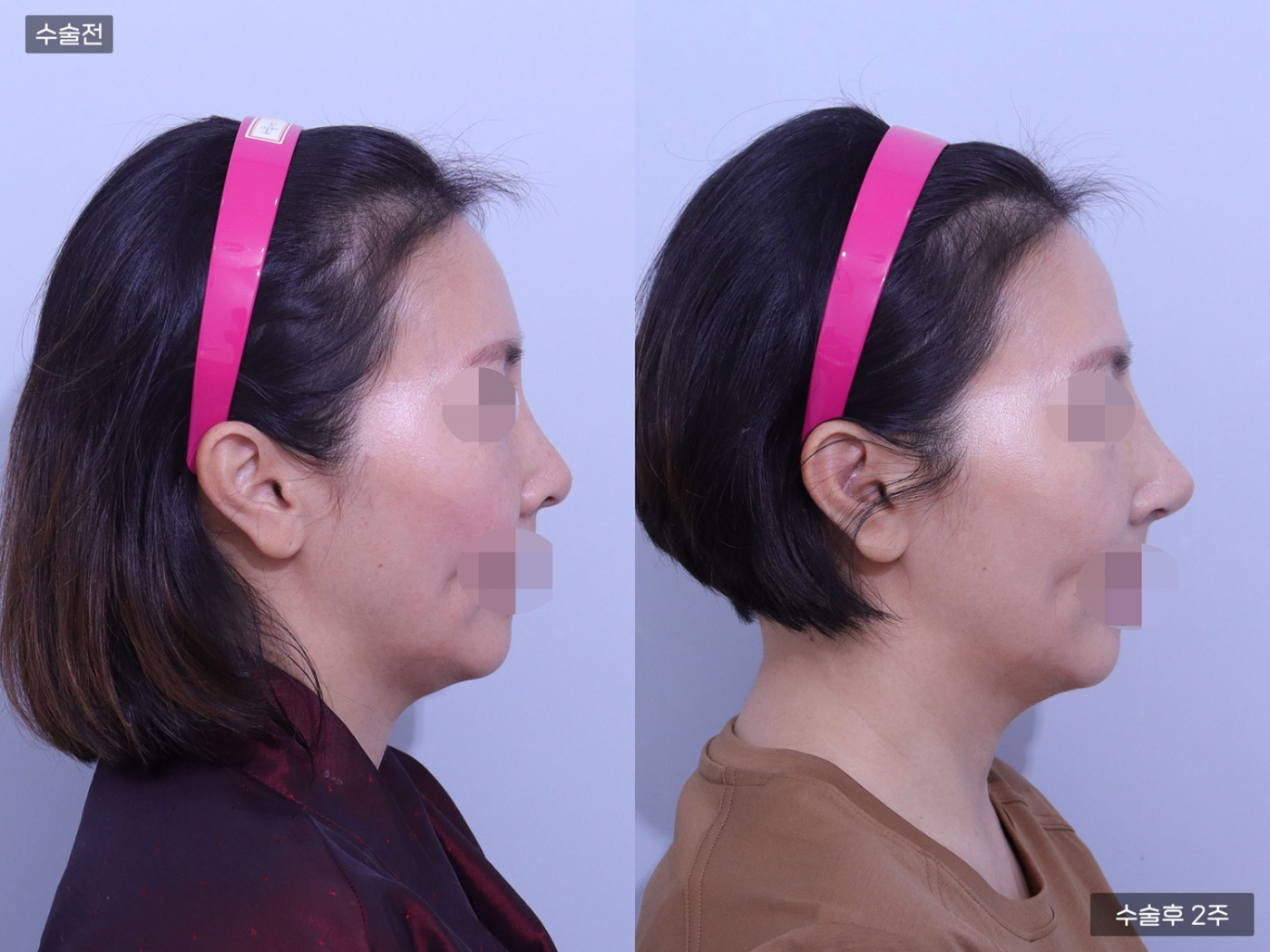 코끝 + 복코 + 매부리코 + 비공내리기