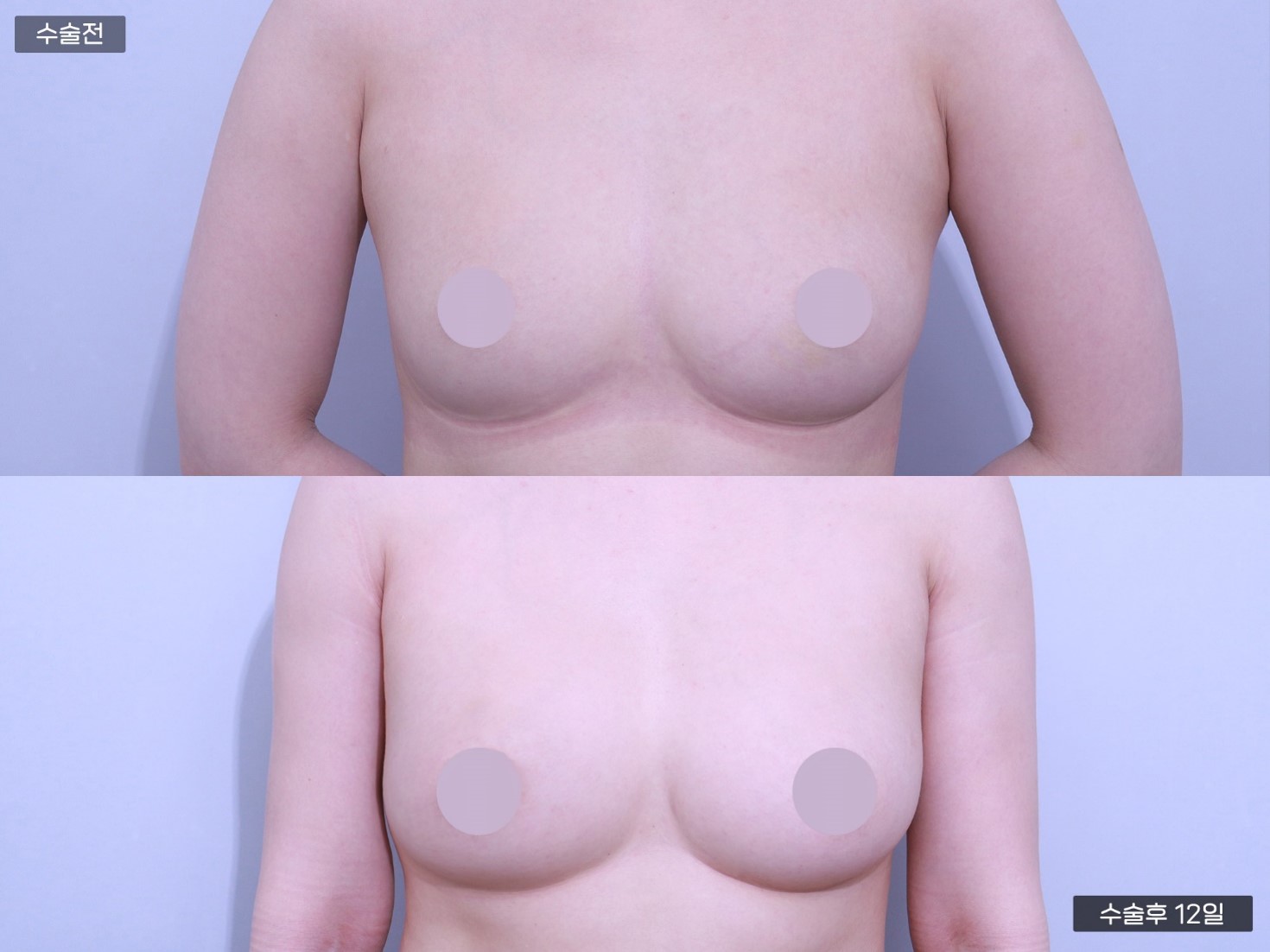 바디 지방이식 [팔] + 줄기세포 가슴지방이식 [100cc + 100cc]