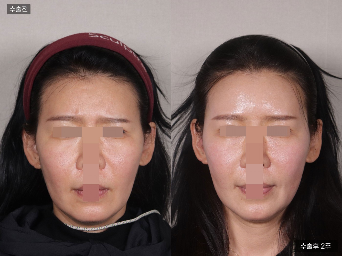 지방이식 [풀페이스]