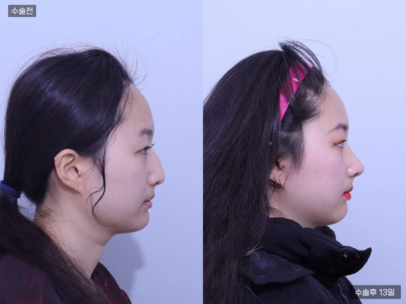 코끝교정 + 매부리코